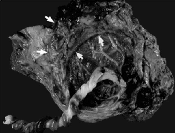 Placenta circumvallata Margini del disco placentare Inserzione delle membrane La piastra coriale è più piccola della piastra basale, la superficie placentare fetale presenta una depressione centrale