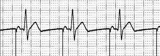 3 Malfunzionamento del PM Il malfunzionamento dei pacemaker può essere determinato da disfunzioni degli elettrocateteri (fratture o dislocamenti), della batteria (esaurimento) o da un alterazione