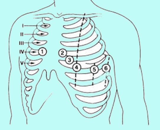 6 Derivazioni precordiali standard 6 derivazioni unipolari trasversali Sono anch esse derivazioni unipolari e visualizzano l attività elettrica cardiaca sul piano TRASVERSALE.