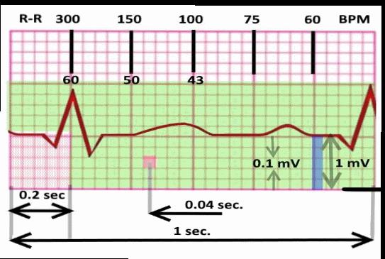 Terzo passo: controlla la frequenza cardiaca La FC può essere dedotta dal tracciato, andando a contare il numero di quadretti grandi da un picco dell onda R e la seguente; ogni quadro rappresenta una