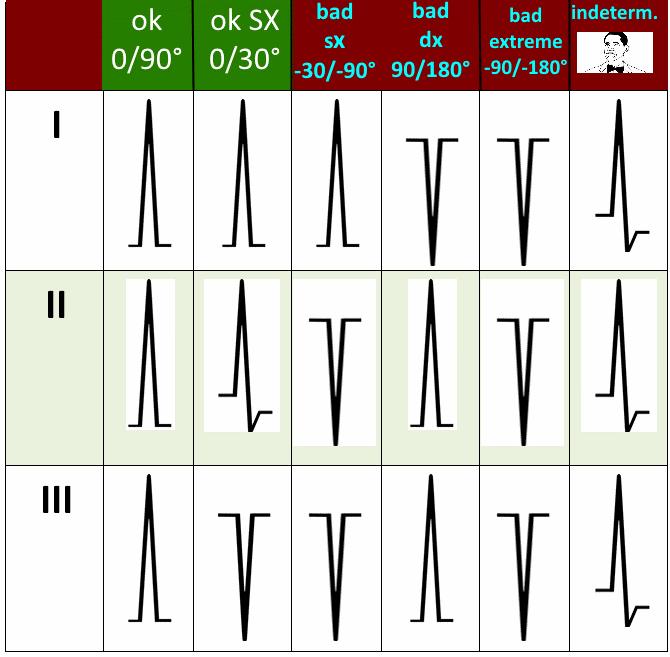 Quinto passo l asse elettrico L asse elettrico è di norma riferito al complesso QRS, che rappresenta la depolarizzazione ventricolare ed è la massa muscolare