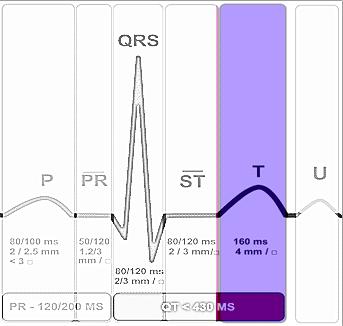 Dodicesimo passo: l onda T Rappresenta la ripolarizzazione dei ventricoli.