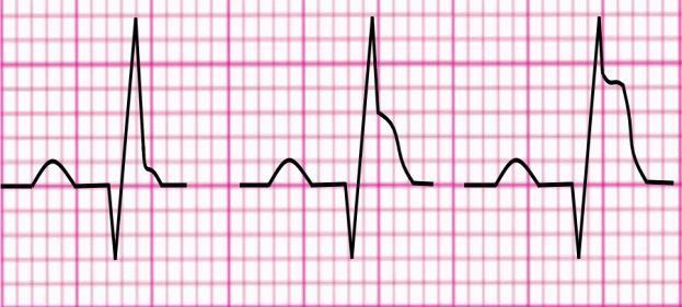 segmento ST è dovuta a infarto miocardico L individuazione di un eventuale IMA dipende dalla corretta interpretazione del segmento ST Depressione del segmento ST Ischemia Infarto sub endocardico