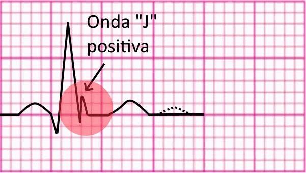 NON trascurare sospetti infarti del ventricolo destro Effettua un ECG con derivazioni DESTRE in caso di sospetto di IMA in ventricolo destro, specie se l ECG mostra una morfologia di lesione sulle