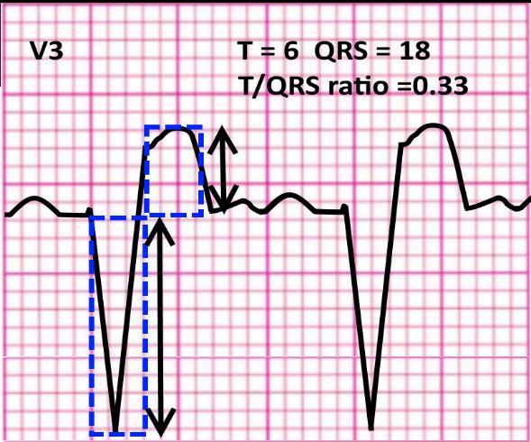 SECONDO CRITERIO: se l ampiezza dell onda T in una sola derivazione compresa tra V1 e V4 ha