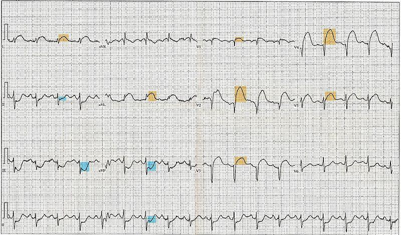 IMA STEMI sopra elevazione ST (tenere conto delle sopraelevazioni; i sottoslivellamenti possono essere