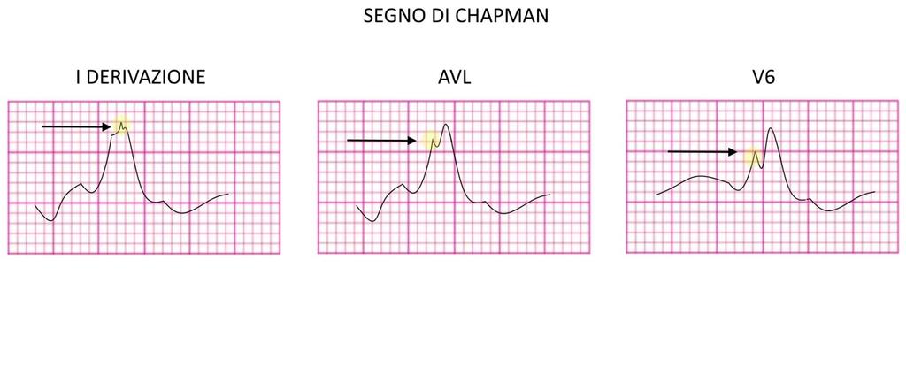 Segno di Chapman Segno di IMA durante un blocco di branca sinistra Si tratta di una dente