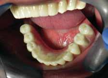 Con le Unita Mobili ad esempio in cinque ore di intervento i pazienti edentuli possono avere arcate dentarie complete su impianti a carico immediato.
