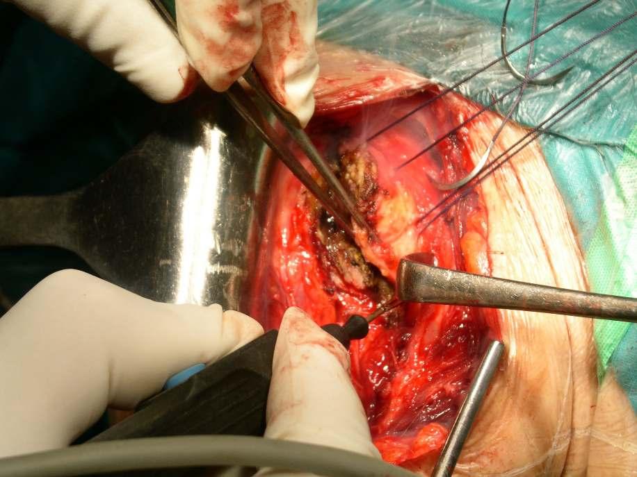Management del sottoscapolare Tenotomiaparzialeo totale Scollamento(peeling) Osteotomia della piccola tuberosità