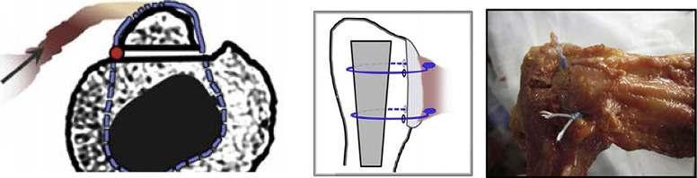 arthroplasty. Christopher C.