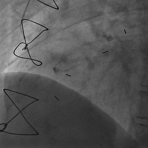 Fredrickson CABG 1987 a 50 anni ;