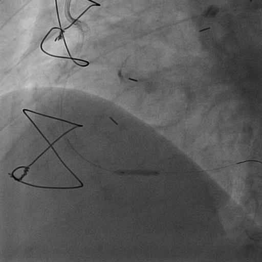 Fredrickson CABG 1987 a 50 anni ;