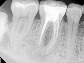 Filtri clinici con un solo