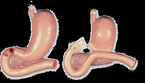 -Deviazione duodenale, riservata a pazienti ad alto rischio con ritardo nella diagnosi o difetti maggiori nella parete duodenale.