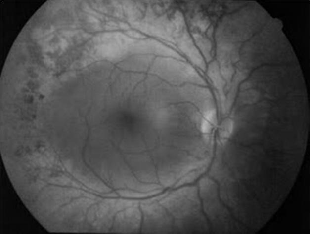 Questa PDE, inizialmente classificata come PDE-V - ma più recentemente distinta come PDE-VI in quanto retinica - è ridotta in