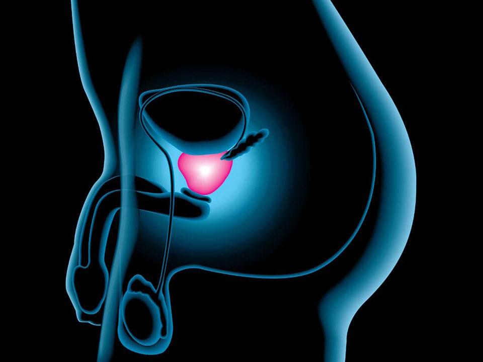 Carcinoma della prostata L associazione con BRCA2 è più forte à RR 4.6 (95% CI 3.5 6.2)1 soprattutto nei giovani (< 65 aa) con RR 7.3 (95% CI 4.7 11.