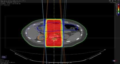 Radioterapia