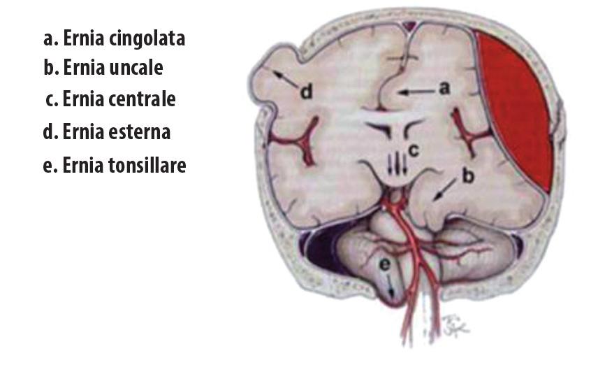 NEUROCHIRURGIA in dieci lezioni FIGURA.5. Possibili quadri delle ernie cerebrali interne, compresa quella verso l esterno, che si realizza quando è presente una craniotomia.