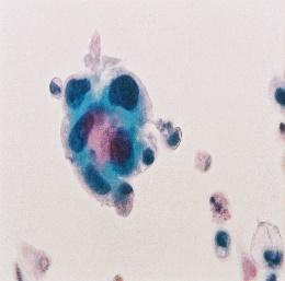 paziente Cellule uroteliali in aggregazione