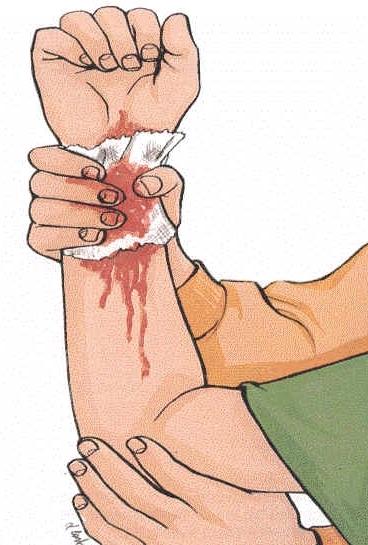 B. Metodo del sollevamento Può essere applicato contemporaneamente alla compressione diretta della ferita quando la sede del sanguinamento sia localizzata in corrispondenza di un arto.