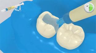5 Pretrattamento della preparazione e applicazione dell adesivo Applicare l'acido fosforico (p.es. Total Etch) prima sullo smalto preparato e poi sulla dentina.