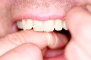 Le patine batteriche (placca e patina della lingua) vengono rimosse in modo meccanico con lo spazzolino da denti e il puliscilingua.