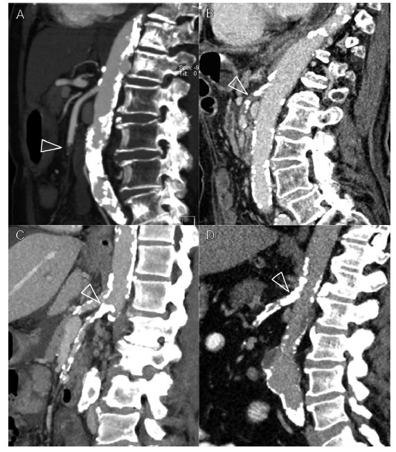 A: embolo occlusivo dell AMS B: Occlusione trombotica C: Stenosi