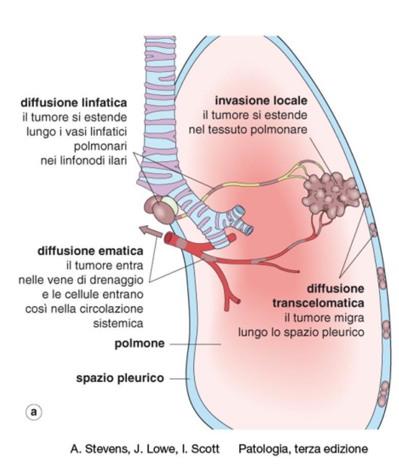 La vie di metastatizzazione Ematica Linfatica