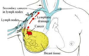 Metastasi