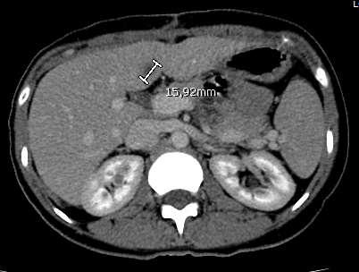 TC post-operatoria Lesione epatica in