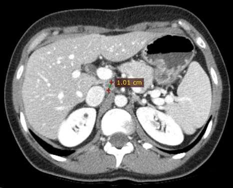 Dopo 8 cicli di FOLFIRI + bevacizumab Lesione epatica in S7 17 mm (ex 35 mm) Tossicità nausea G1 mucosite G2