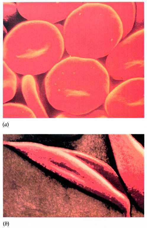 Basi molecolari dell anemia a cellule falciformi (HbS) A3(6)β Val-His-Leu-Thr-Pro-Glu-Glu-Lys Val-His-Leu-Thr-Pro-Val-Glu-Lys residuo mutato in