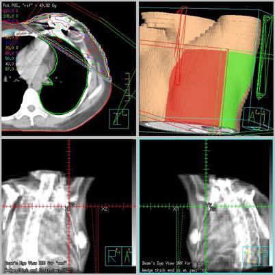 Modalità di trattamento! Analoghe a quelle impiegate dopo terapia conservativa! Parametri dosimetrici di riferimento analoghi Copertura PTV 95-107% polmone V20 < 20-30% cuore Dmax, V20 Tecnica 3D!