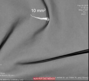 gonnellino integrati: 1 cm² nel collo e 0,2 cm² nella zona riproduttiva Collare Paratiroide Gonnellino Lesione con area