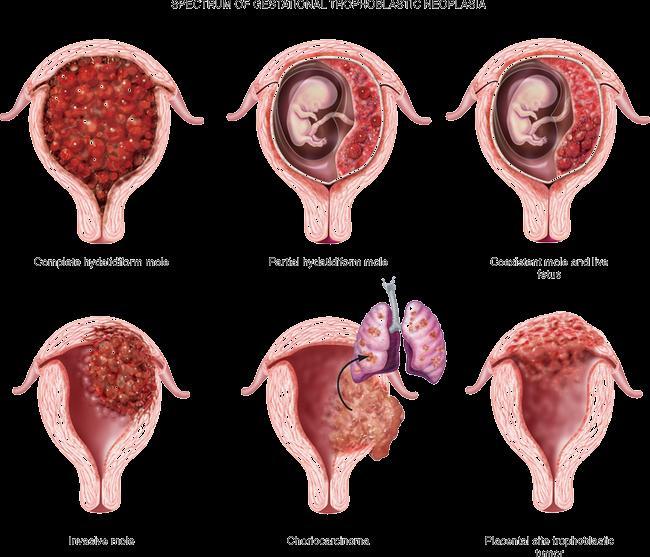 Mola idatiforme In a complete molar pregnancy, an empty egg is fertilized by one or two sperm, and all of the genetic material is from the