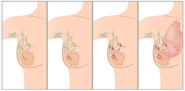 CHE COS è Il tumore al seno è una formazione di tessuto costituito da cellule