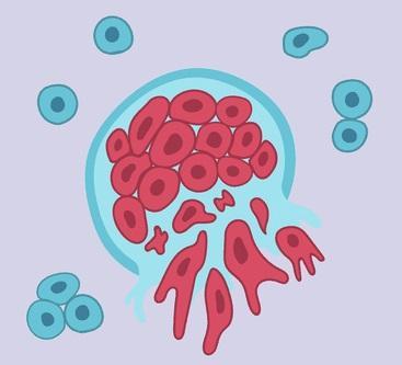 circostanti, né a produrre metastasi.