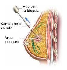 una biopsia, cioè ad un prelievo mediante un ago inserito nell