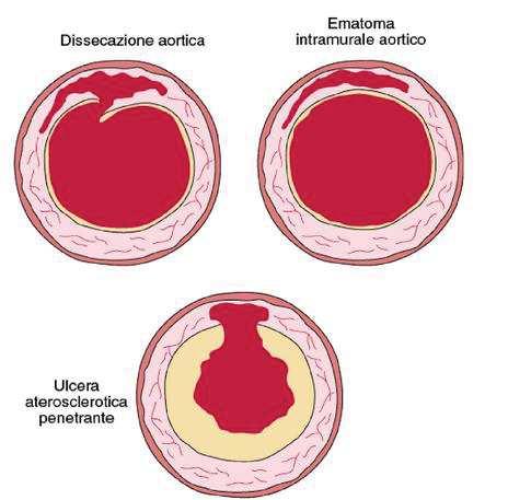 5.SINDROMI AORTICHE ACUTE INQUADRAMENTO EPIDEMIOLOGICO E CLINICO Il termine Sindromi Aortiche Acute (SAA) comprende uno spettro di patologie aortiche che, seppur caratterizzate da quadri