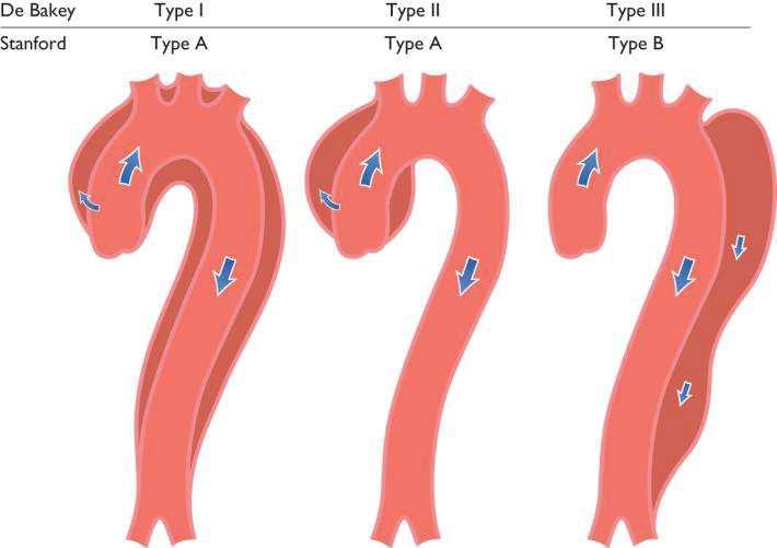 Figura 2. Classification of aortic dissection localization. ESC 2014 5.2.2 Ematoma Intramurale (EIM) Nell EIM il processo che interessa la tunica media origina dalla rottura dei vasa vasorum e si estende principalmente lungo l asse circonferenziale.