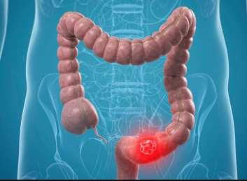 Quattro studi clinici di screening del carcinoma colorettale condotti con la RSO fecale hanno riscontrato un beneficio in riduzione della mortalità tra i 50,144 adulti di età compresa tra i 70 e gli