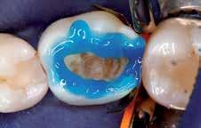 idrofile e idrofobiche in un solo prodotto. Esso è pertanto tollerante all umidità e penetra bene nei tubuli dentinali pervi.