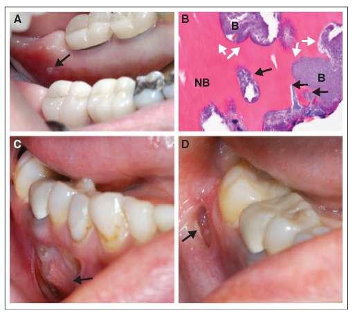 Avastin (Bevacizumab) e NON con BPs (1