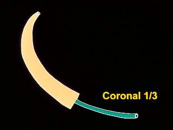 del 1998. L Informatore Endodontico Vol. 5, Nr. 1 2002 Il Finisher F1 ha il diametro in punta 20 e la conicità 0,07 negli ultimi 3 mm, mentre più coronalmente presenta conicità inferiori.