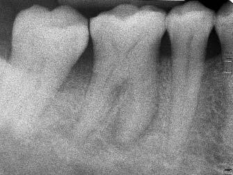 E stata posizionata una banda ortodontica, allo scopo di diagnosticare l estensione della frattura.