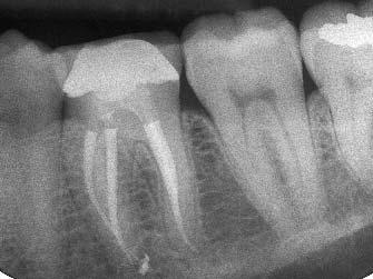 Figura 4d Radiografia del molare superiore con quattro canali, prima di completare il riempimento apico-coronale del canale mesiopalatino.