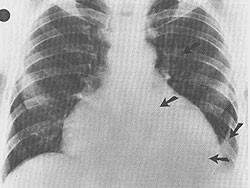 linfadenite satellite / generalizzata epato splenomegalia meningoencefalite o miocardite (2-5% dei casi) FASE CRONICA