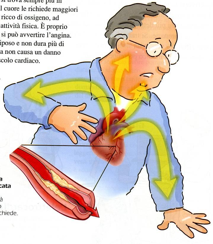 Le coronarie L infarto miocardico all interno delle pareti delle arterie coronarie danneggiate si formano depositi di