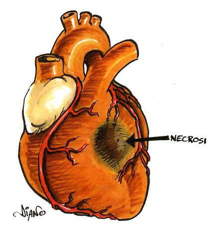 Cardiopatia ischemica L infarto del miocardio trombo