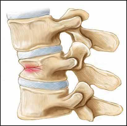 Men with prostate cancer experiencing a fracture had a 1.